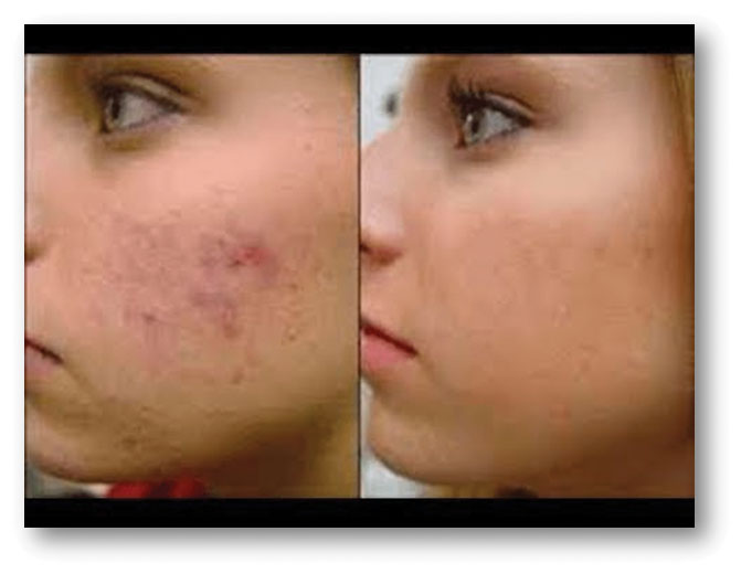 acne prima e dopo il trattamento
