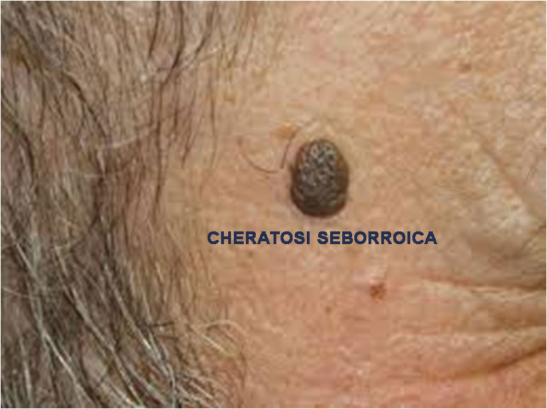 cheratosi seborroica