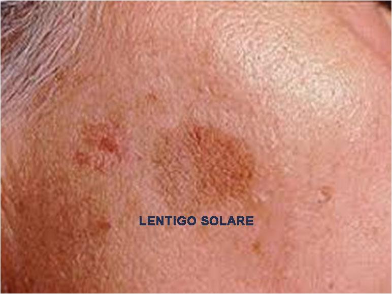 lentigo solare